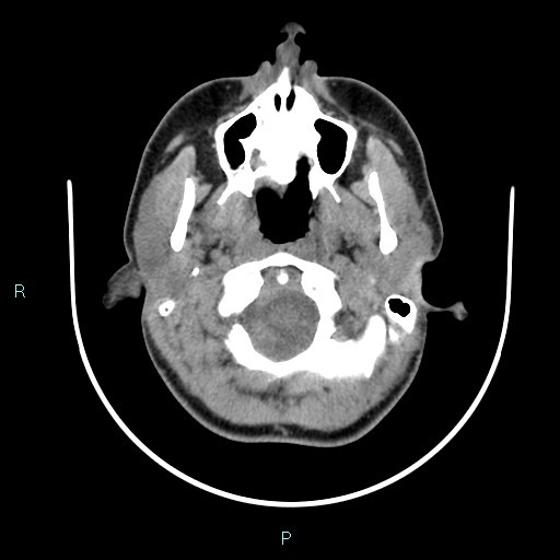 File:Cervical thymic cyst (Radiopaedia 88632-105335 Axial non-contrast 99).jpg