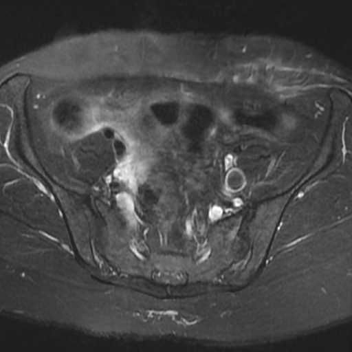 File:Cesarian section scar endometriosis (Radiopaedia 66520-75799 Axial T2 fat sat 5).jpg
