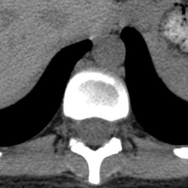 File:Chance fracture (Radiopaedia 36521-38081 Axial non-contrast 46).jpg