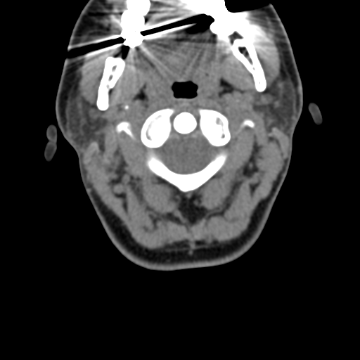 Chiari I malformation and obstructive hydrocephalus (Radiopaedia 41185-43981 D 36).png