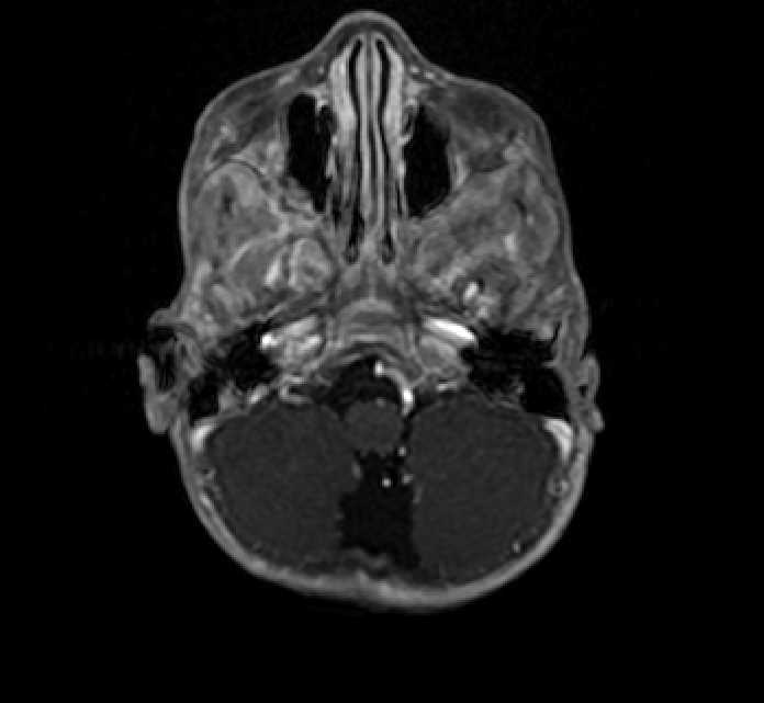 Chiasmatic-hypothalamic glioma (Radiopaedia 90079-107252 Axial T1 C+ 10).jpg