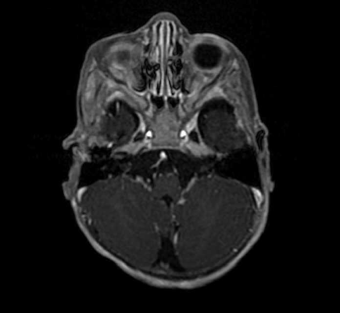 Chiasmatic-hypothalamic glioma (Radiopaedia 90079-107252 Axial T1 C+ 15).jpg