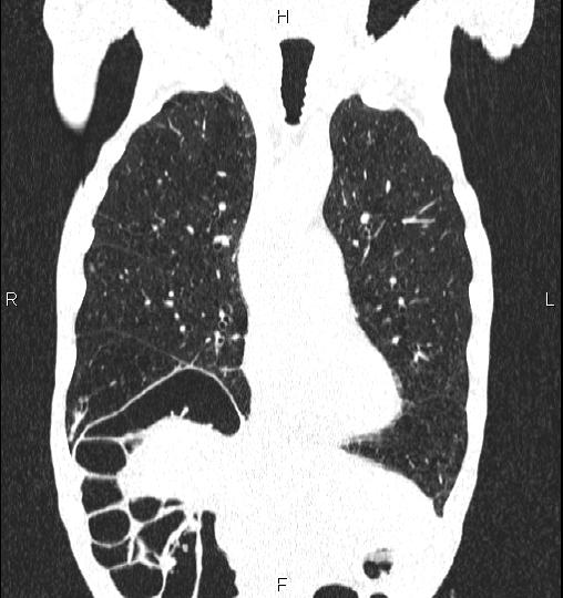 Chilaiditi sign (Radiopaedia 88839-105611 Coronal lung window 22).jpg