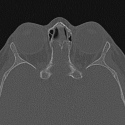Choanal atresia (Radiopaedia 88525-105975 Axial bone window 97).jpg