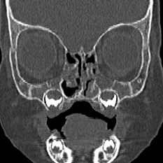 Choanal atresia (Radiopaedia 88525-105975 Coronal bone window 33).jpg