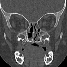 Choanal atresia (Radiopaedia 88525-105975 Coronal bone window 53).jpg