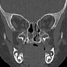 File:Choanal atresia (Radiopaedia 88525-105975 Coronal bone window 58).jpg