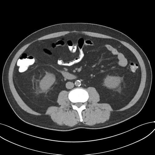 File:Cholecystitis with focal perforation and hepatic abscess (Radiopaedia 37189-38945 Axial non-contrast 45).png