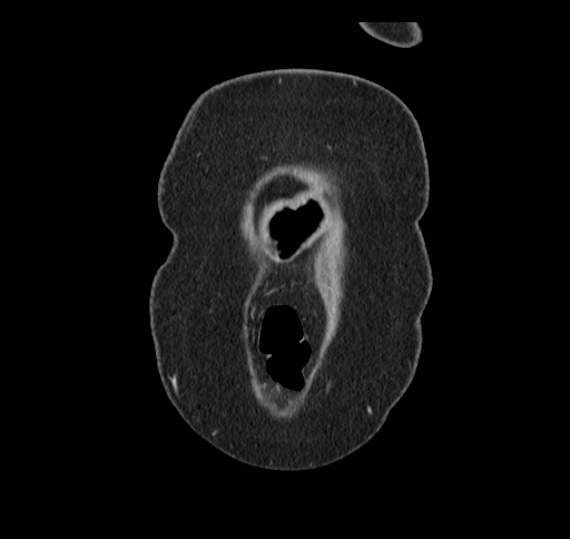 File:Cholecystoduodenal fistula (Radiopaedia 48959-54022 B 8).jpg