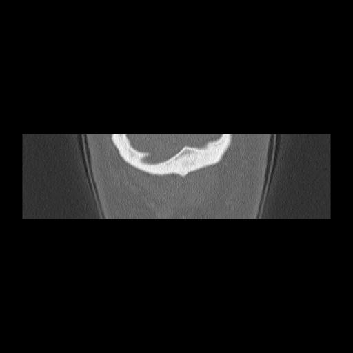 Cholesteatoma (Radiopaedia 84946-100455 Coronal bone window 165).jpg