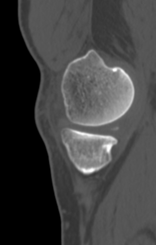 Chondrocalcinosis (Radiopaedia 82862-97173 Sagittal bone window 10).jpg