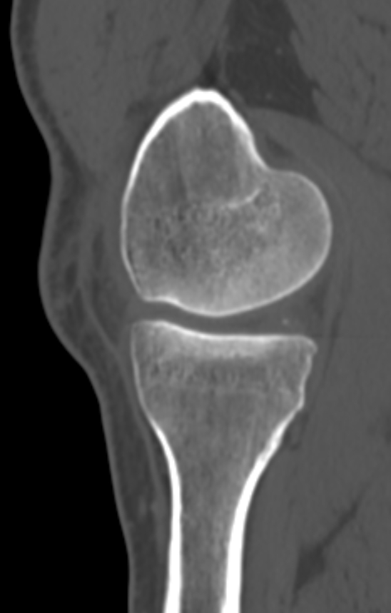 Chondrocalcinosis (Radiopaedia 82862-97173 Sagittal bone window 19).jpg