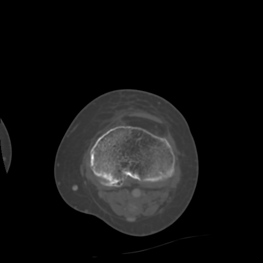 Chondrosarcoma - femur (Radiopaedia 64187-72954 Axial bone window 56).jpg