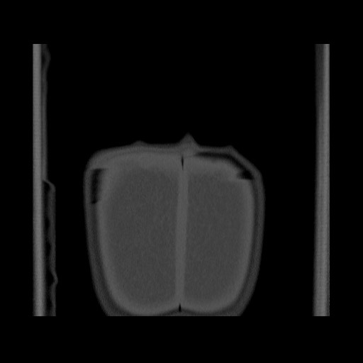 Chondrosarcoma of iliac wing (Radiopaedia 63861-72599 Coronal bone window 116).jpg