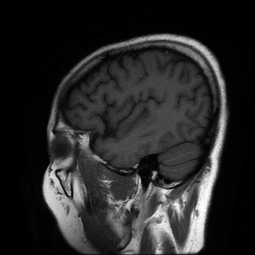 File:Chordoid glioma of third ventricle (Radiopaedia 91612-109340 Sagittal T1 22).jpg