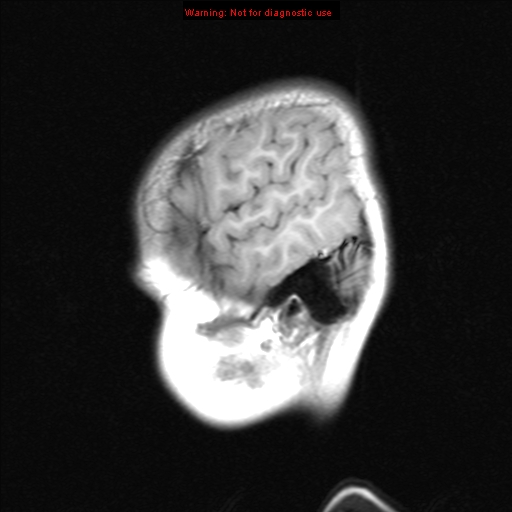 File:Choroid plexus papilloma (Radiopaedia 8466-9290 Sagittal T1 19).jpg