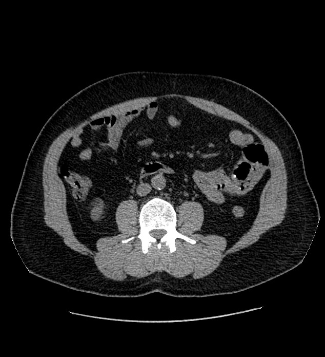 Chromophobe renal cell carcinoma (Radiopaedia 84337-99693 Axial non-contrast 76).jpg