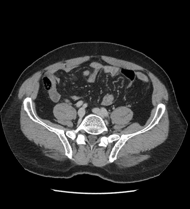 Chromophobe renal cell carcinoma (Radiopaedia 86879-103083 C 106).jpg