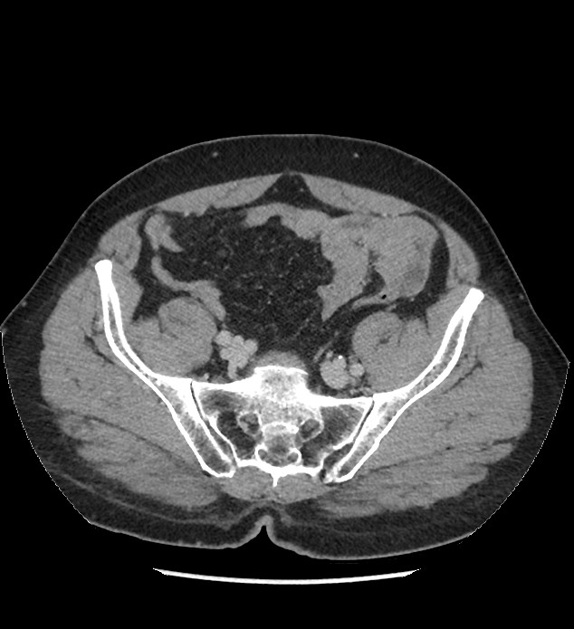 Chromophobe renal cell carcinoma (Radiopaedia 86879-103083 C 118).jpg