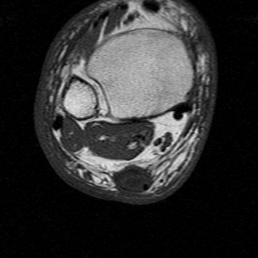 File:Chronic Achilles tendon rupture (Radiopaedia 15262-15100 Axial T1 8).jpg