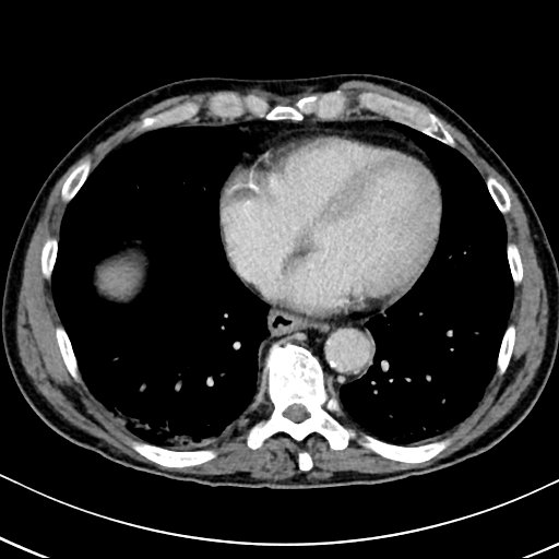 Chronic appendicitis complicated by appendicular abscess, pylephlebitis and liver abscess (Radiopaedia 54483-60700 B 15).jpg