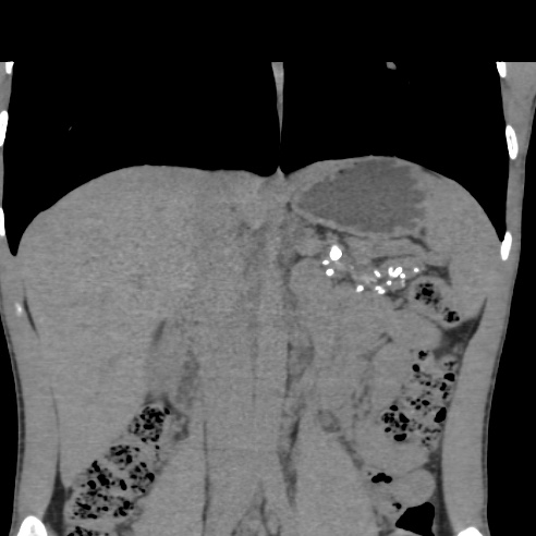 File:Chronic calcific pancreatitis (Radiopaedia 56280-62953 Coronal non-contrast 15).jpg