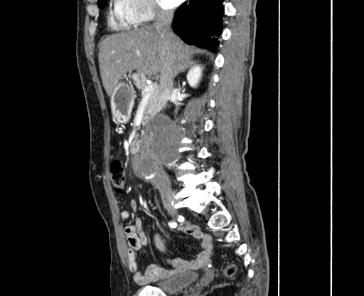 Chronic contained rupture of abdominal aortic aneurysm with extensive erosion of the vertebral bodies (Radiopaedia 55450-61901 B 16).jpg