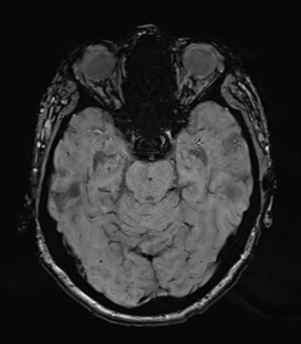 Chronic hypertensive encephalopathy (Radiopaedia 39993-42482 Axial SWI 30).png