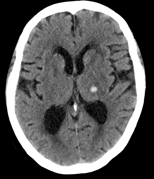 File:Chronic hypertensive encephalopathy (Radiopaedia 39993-42485 Axial non-contrast 18).png