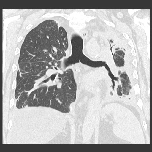 Chronic lung allograft dysfunction - restrictive form (Radiopaedia 60595-68316 Coronal lung window 64).jpg