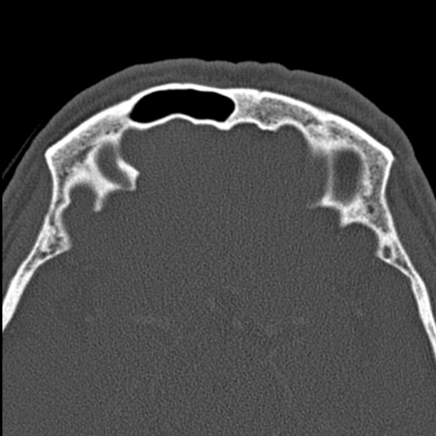 Chronic maxillary sinusitis (Radiopaedia 27879-28116 Axial bone window 47).jpg