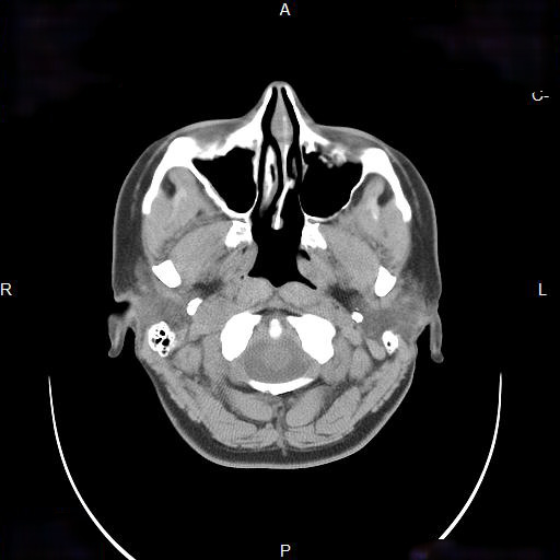 File:Chronic maxillary sinusitis with a foreign body (dental filling material) (Radiopaedia 7811-8639 Axial non-contrast 5).jpg