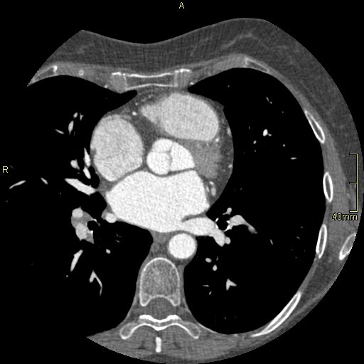 Chronic pulmonary embolism (Radiopaedia 73073-85094 Axial C+ CTPA 86).jpg