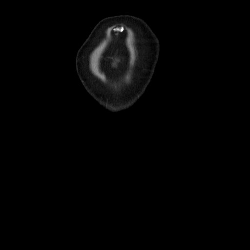 Chyluria following renal ablation (Radiopaedia 81087-94678 C 27).jpg