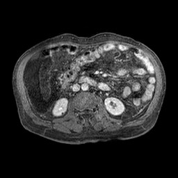 Cirrhosis and hepatocellular carcinoma in the setting of hemochromatosis (Radiopaedia 75394-86594 Axial T1 C+ fat sat 269).jpg