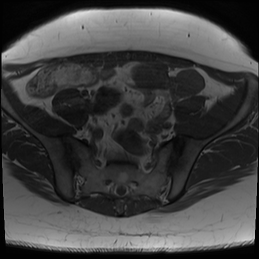 File:Class II Mullerian duct anomaly- unicornuate uterus with rudimentary horn and non-communicating cavity (Radiopaedia 39441-41755 Axial T1 7).jpg