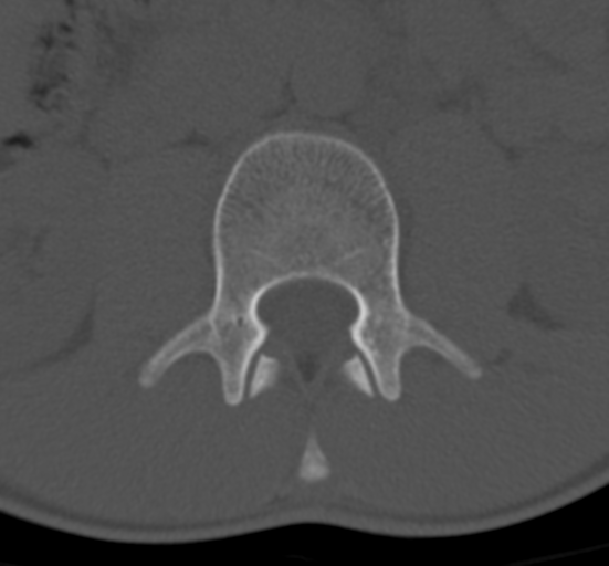 Clear cell meningoma - lumbar spine (Radiopaedia 60116-67691 Axial bone window 25).png