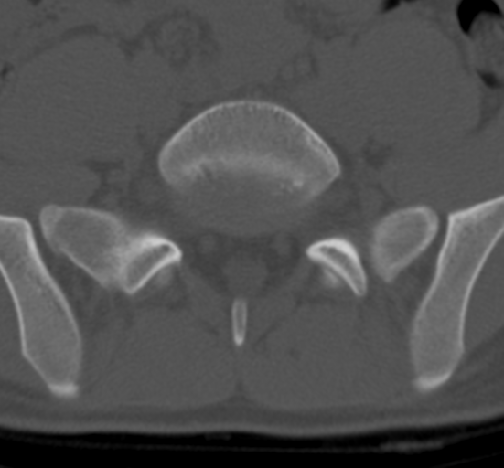 Clear cell meningoma - lumbar spine (Radiopaedia 60116-67691 Axial bone window 65).png