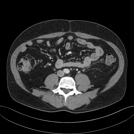 File:Clear cell renal cell carcinoma (Radiopaedia 61449-69393 E 69).jpg