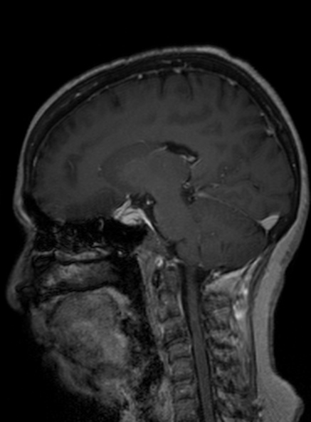 Clival meningioma (Radiopaedia 53278-59248 Sagittal T1 C+ 238).jpg