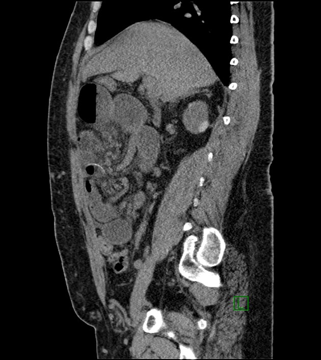 Closed-loop small bowel obstruction-internal hernia (Radiopaedia 78439-91096 C 92).jpg