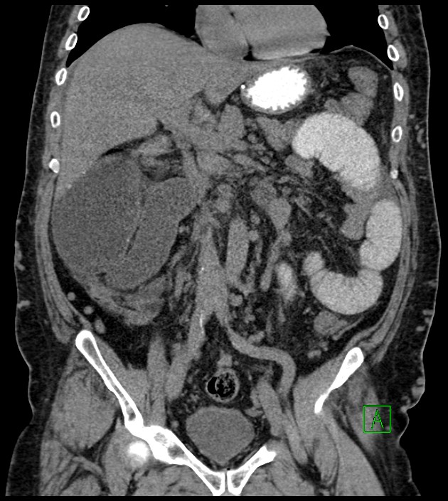 Closed-loop small bowel obstruction-internal hernia (Radiopaedia 78439-91096 Coronal non-contrast 50).jpg