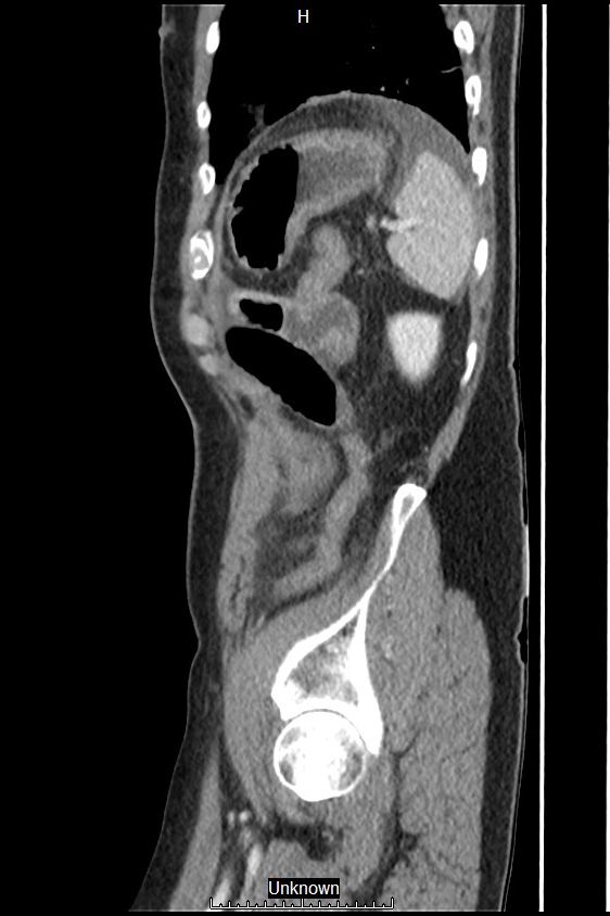 Closed loop bowel obstruction and ischemia (Radiopaedia 86959-103180 C 7).jpg