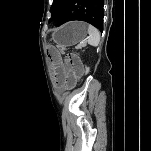 File:Closed loop obstruction due to adhesive band, resulting in small bowel ischemia and resection (Radiopaedia 83835-99023 F 149).jpg