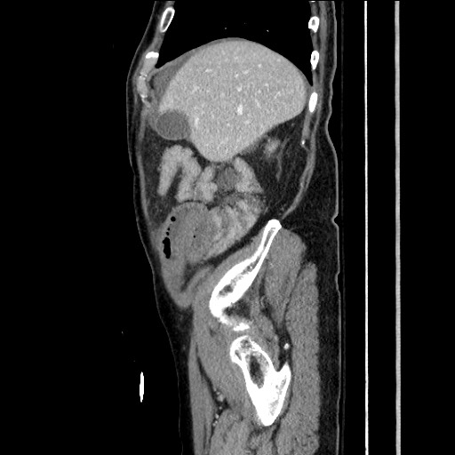 File:Closed loop obstruction due to adhesive band, resulting in small bowel ischemia and resection (Radiopaedia 83835-99023 F 45).jpg