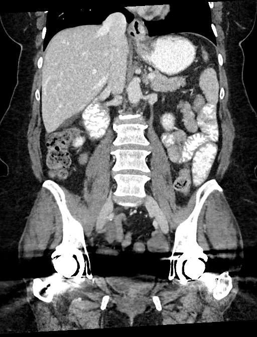 Closed loop small bowel obstruction - adhesions (Radiopaedia 59078-66369 B 69).jpg