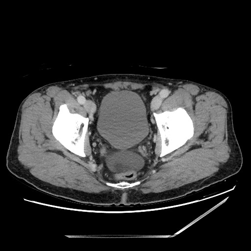 File:Closed loop small bowel obstruction - omental adhesion causing "internal hernia" (Radiopaedia 85129-100682 A 154).jpg