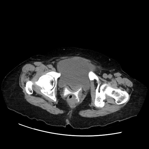 File:Closed loop small bowel obstruction due to adhesive band, with intramural hemorrhage and ischemia (Radiopaedia 83831-99017 Axial non-contrast 152).jpg