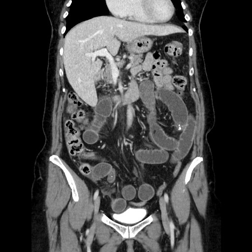 Closed loop small bowel obstruction due to adhesive bands - early and late images (Radiopaedia 83830-99015 B 51).jpg
