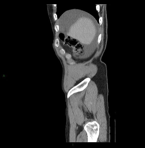 File:Closed loop small bowel obstruction with ischemia (Radiopaedia 84180-99456 C 10).jpg